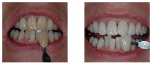 hampaiden-valkaisu-esimerkki-1