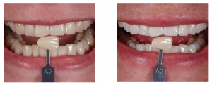 hampaiden-valkaisu-esimerkki-2